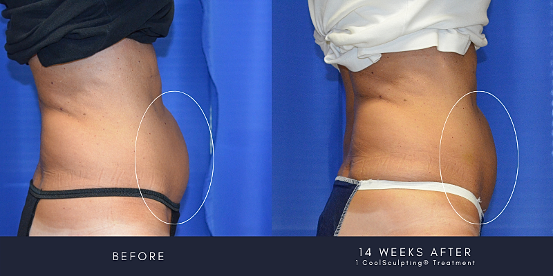 Coolsculpting Before & After