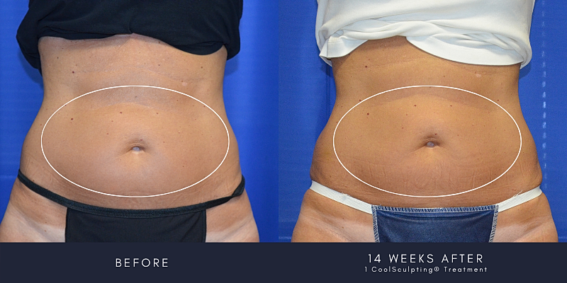 Coolsculpting Before & After