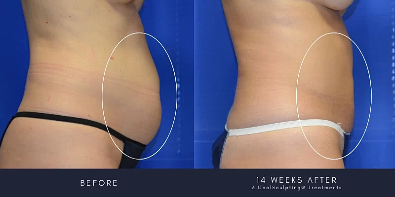 Coolsculpting Before & After