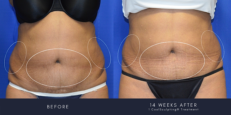 Coolsculpting Before & After