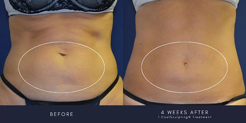 Coolsculpting Before & After