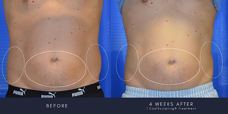 Coolsculpting Before & After