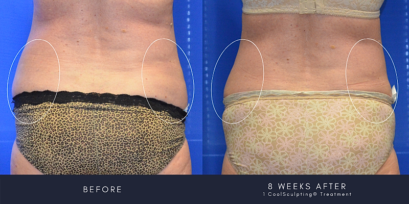 Coolsculpting Before & After