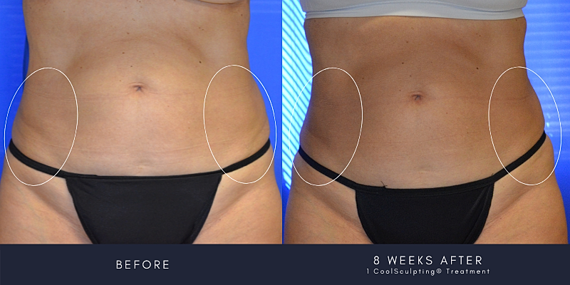 Coolsculpting Before & After