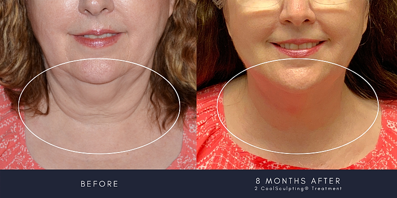 Coolsculpting Before & After