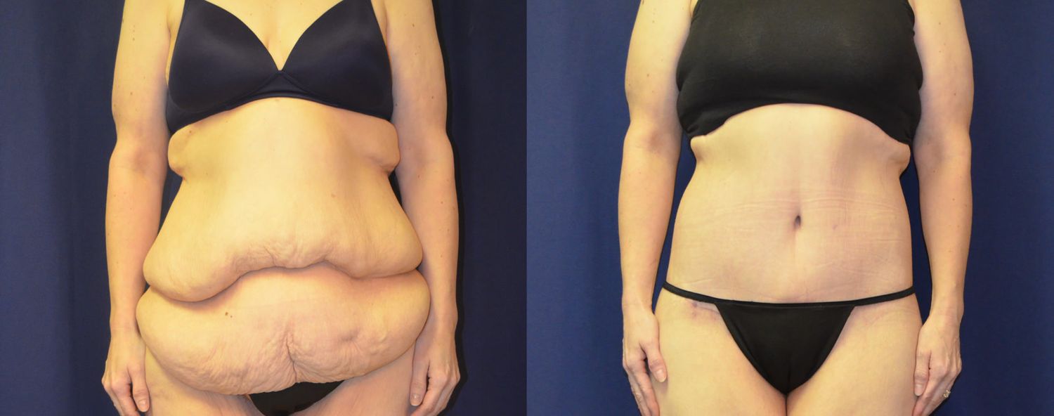 Body Contouring Massive Weightloss Before & After