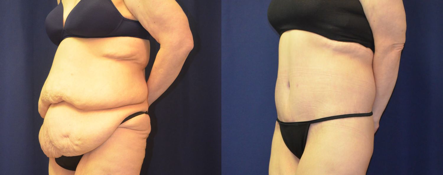 Body Contouring Massive Weightloss Before & After