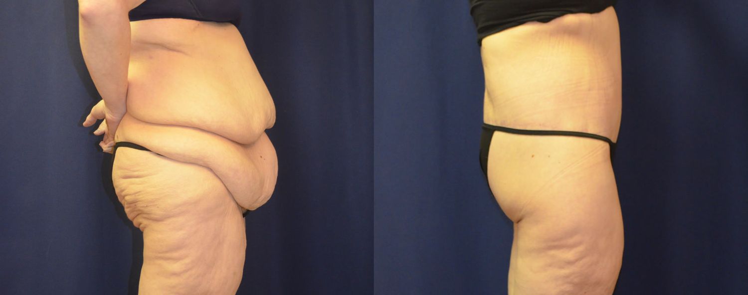 Body Contouring Massive Weightloss Before & After