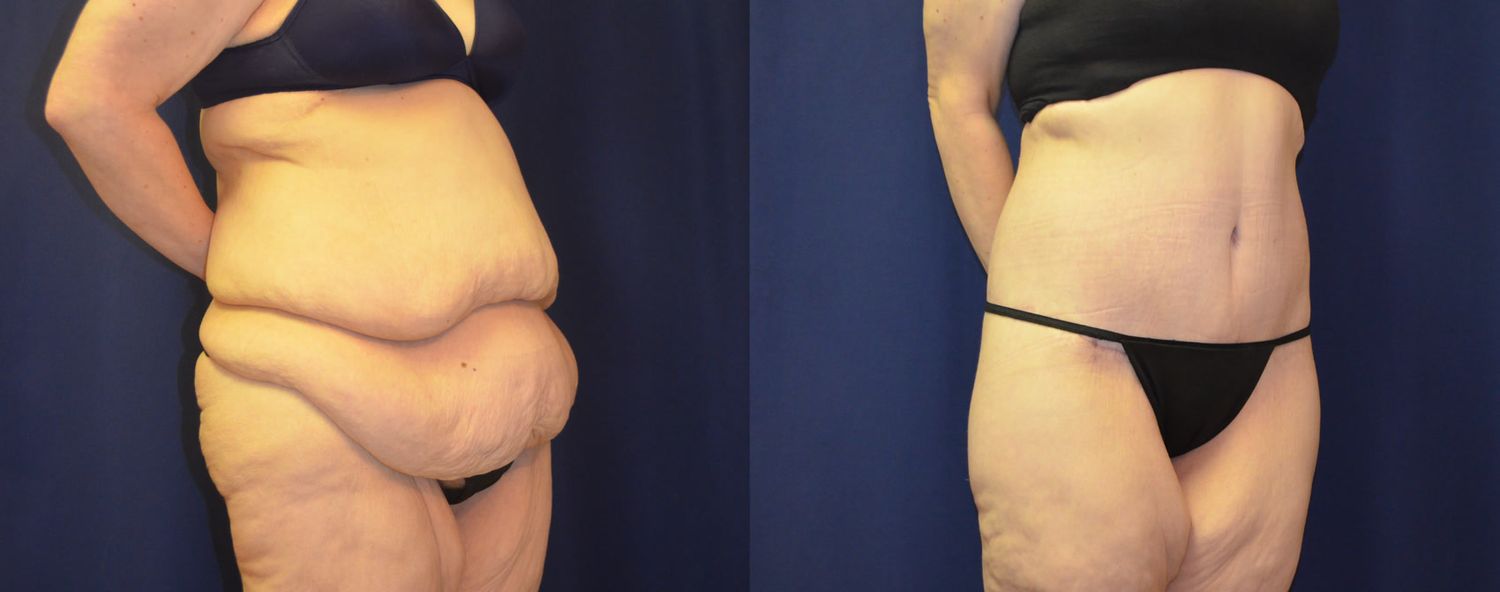 Body Contouring Massive Weightloss Before & After