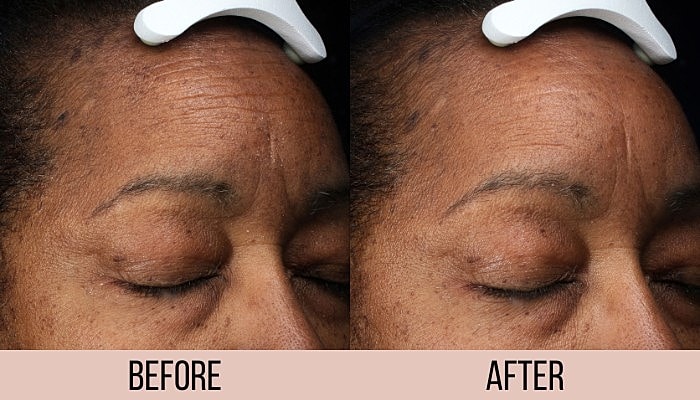 Skin improvement before and after treatment comparison.