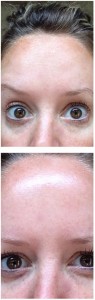 deep forehead wrinkles botox before and after