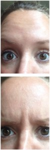 botox before and after forehead lines