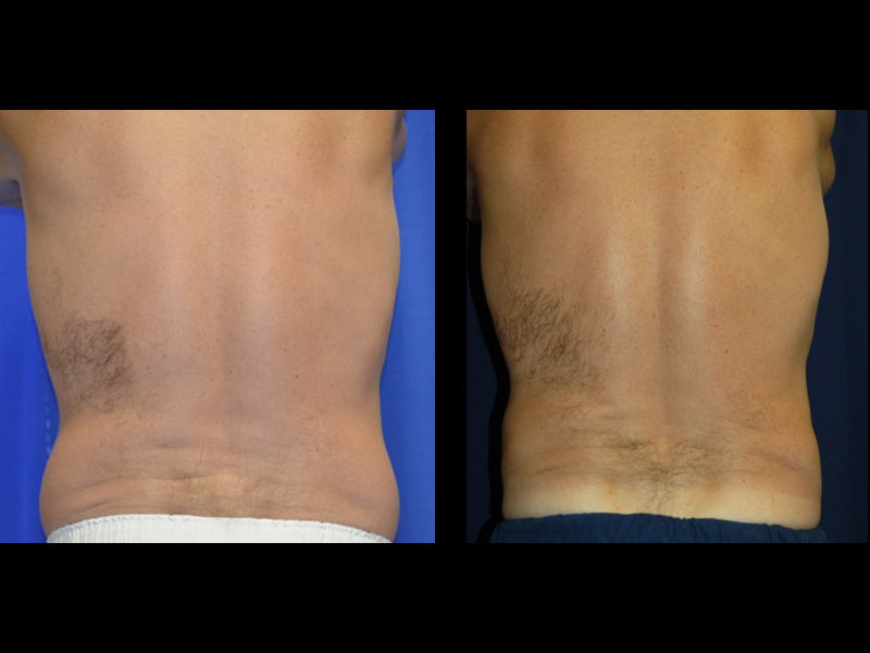 Before and After Coolsculpting Results