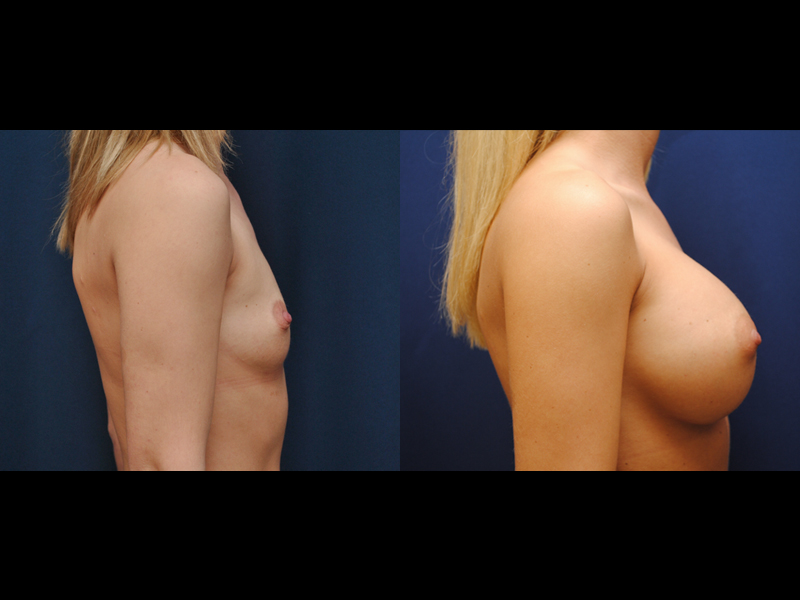 Before and After Breast Augmentation Results