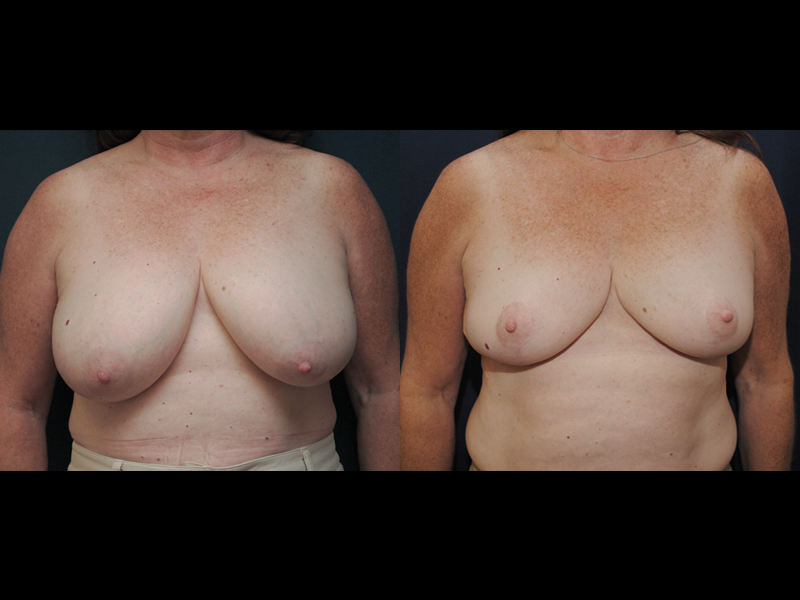 Before and After Breast Reduction Results