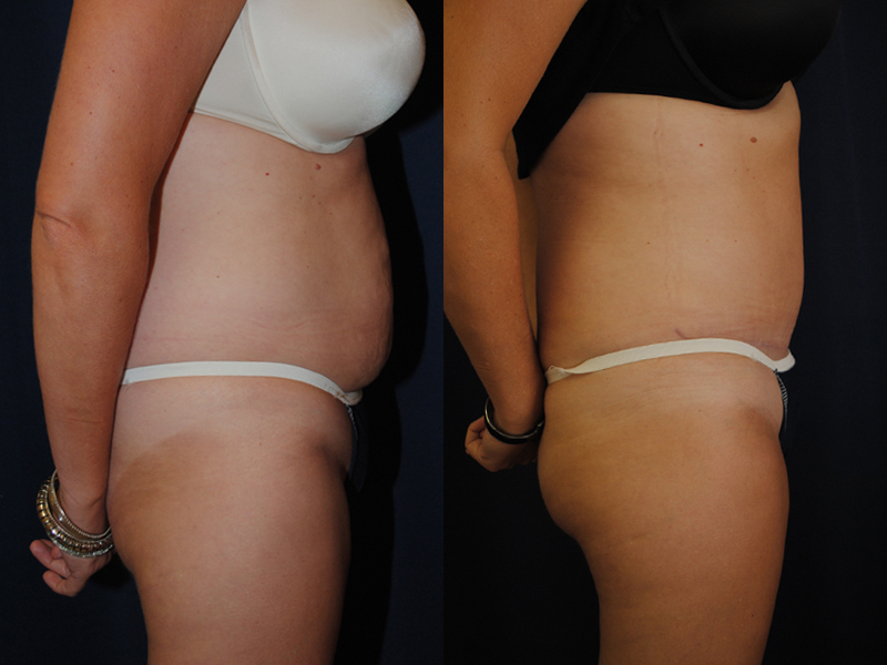 Before and After Tummy Tuck Results