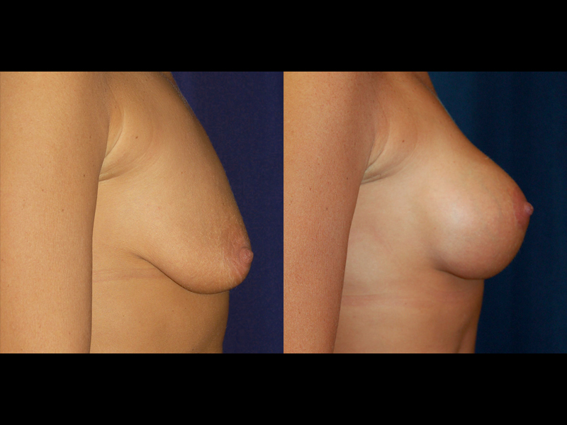 Before and After Breast Augmentation and Lift Results