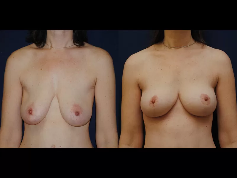 Before and After Breast Augmentation Lift Results