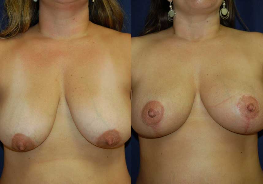 Before and After Breast Augmentation and Lift Results