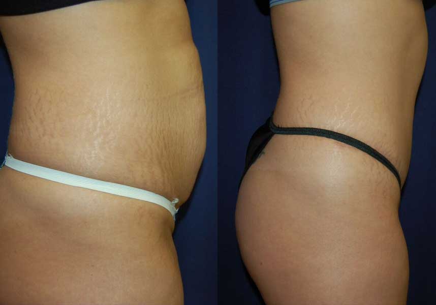 Before and After Abdominoplasty Results