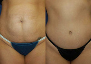 Before and After Abdominoplasty Results