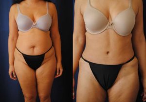 Before and After Liposuction Results