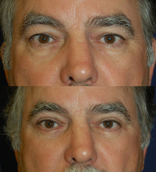 Before and After Eyelid Results