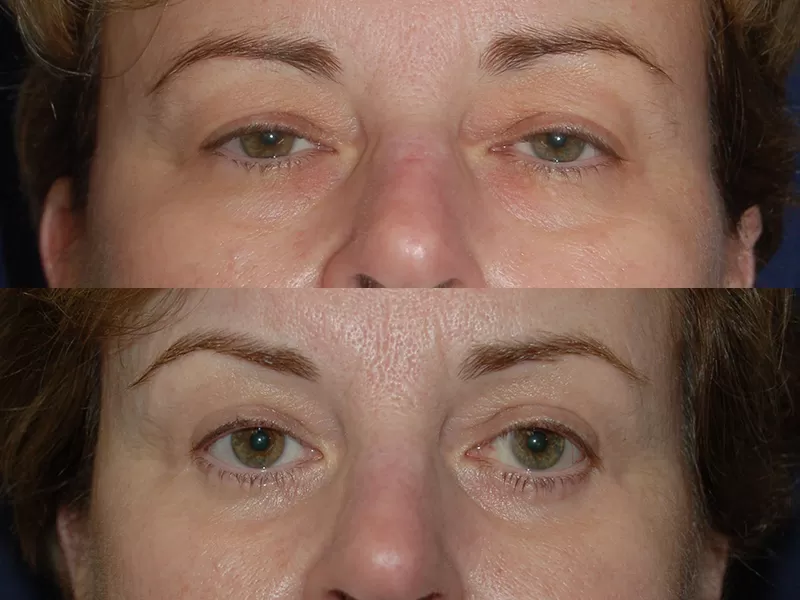 Before and After Eyelid Results