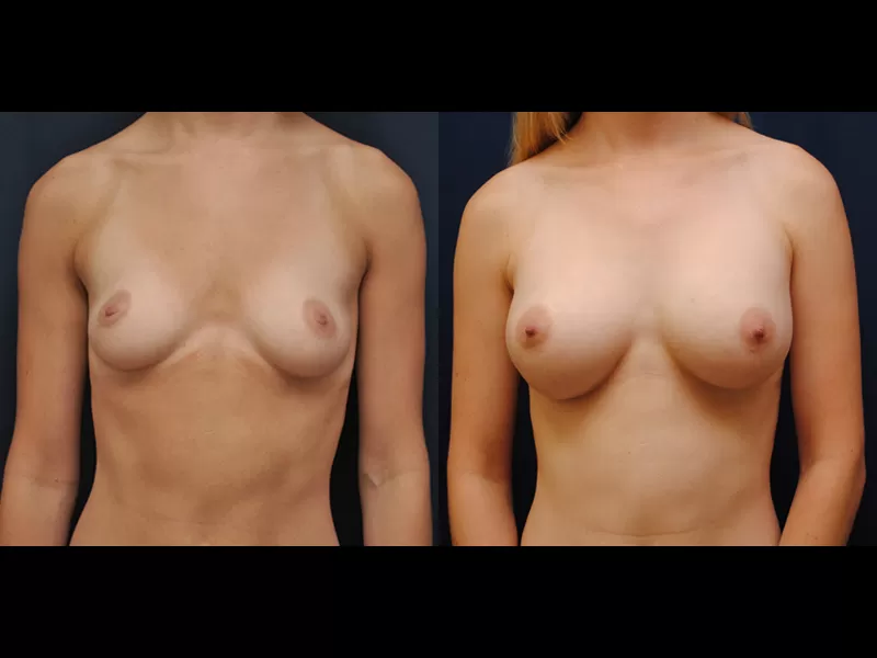 Before and After Breast Augmentation Results