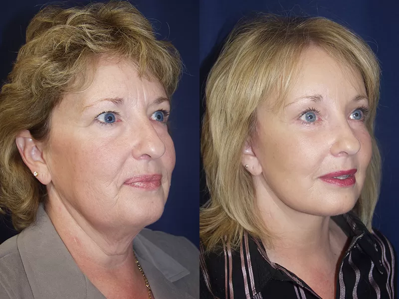 Before and After Facial Rejuvenation Results