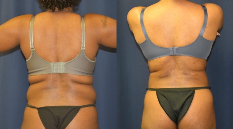 Before and After Body Contouring Results