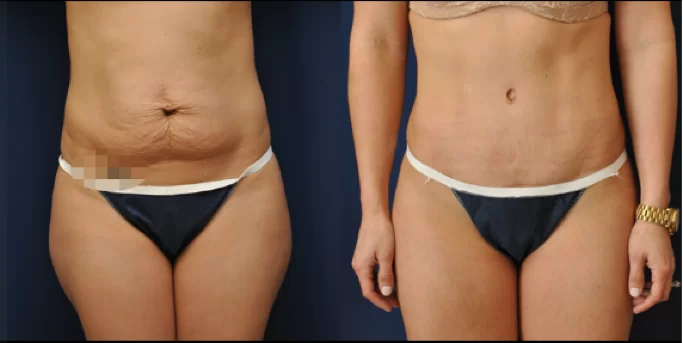 A popular surgery often a part of the mommy makeover procedure is a tummy tuck.