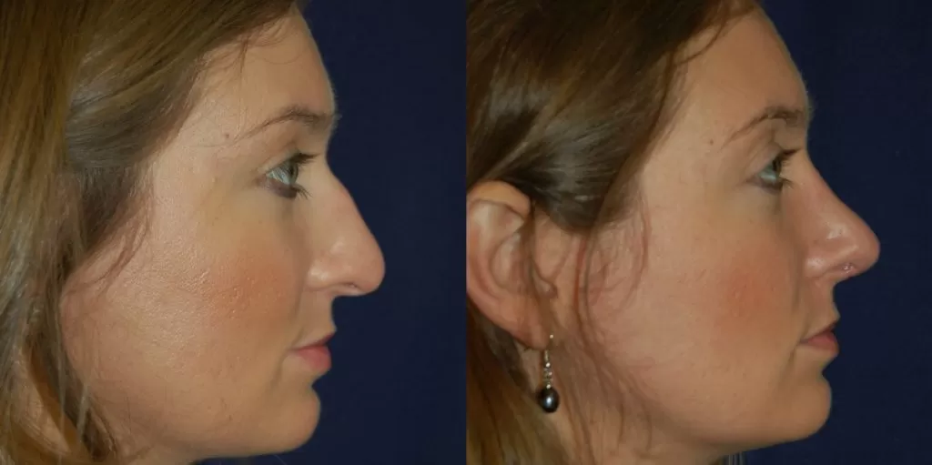 how to prepare for nose surgery