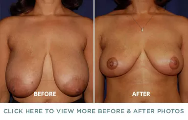Breast Reduction – Charlotte Plastic Surgery