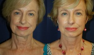 Before and After Facelift Results