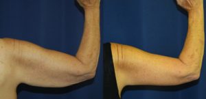 Before and After Brachioplasty Results