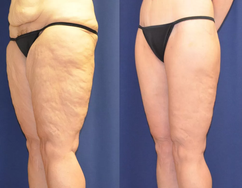 Before and After Liposuction Results