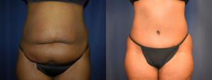 Before and After Tummy Tuck Results