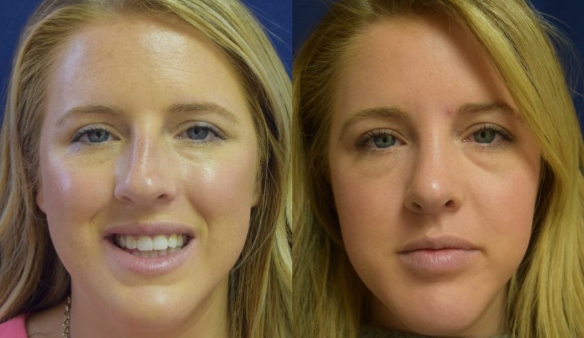 Nose Job Recovery