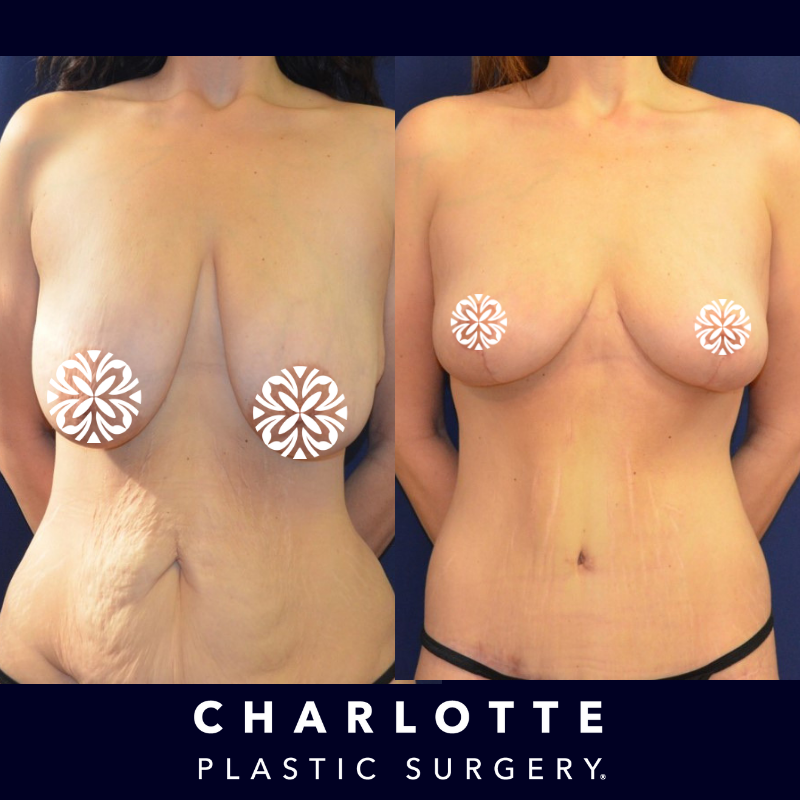 difference between a breast reduction and a breast lift