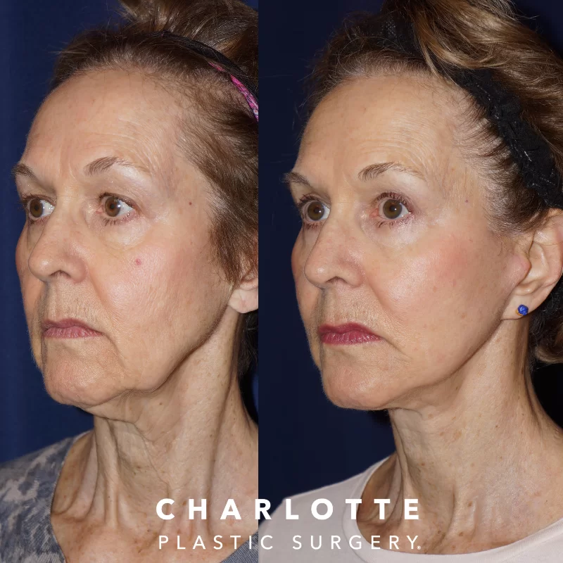 The Different Types of Facelifts - Which Technique is Best For You?