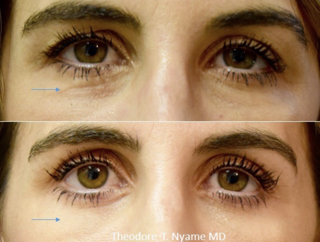 How to Reduce the Bags Under Your Eyes: Rostami OPC: Oculofacial
