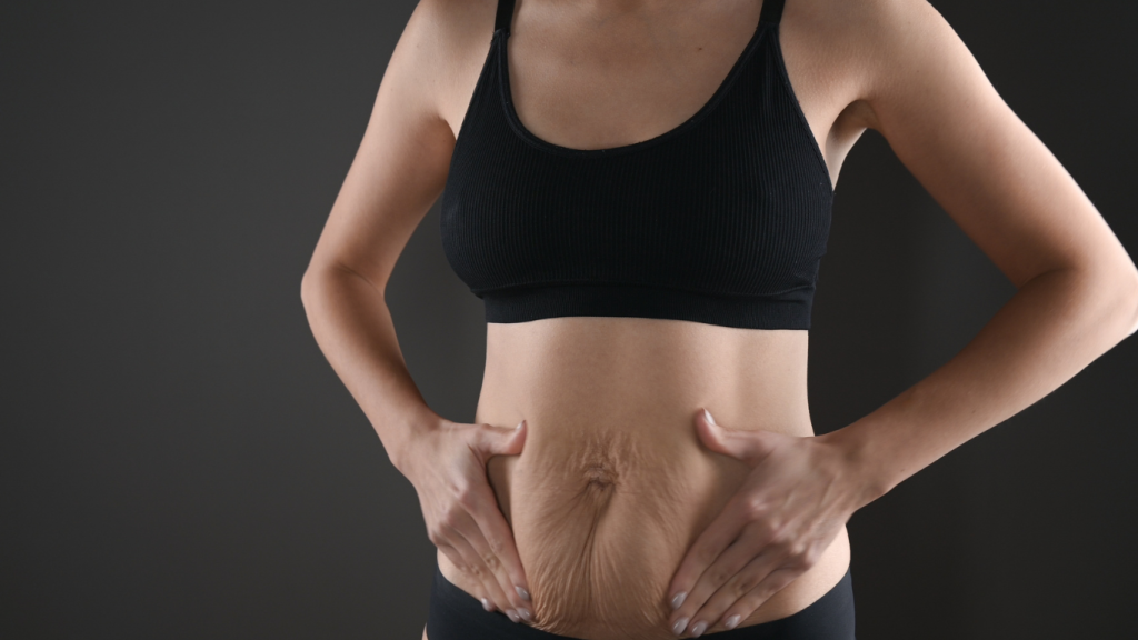 can you get a tummy tuck after a c-section