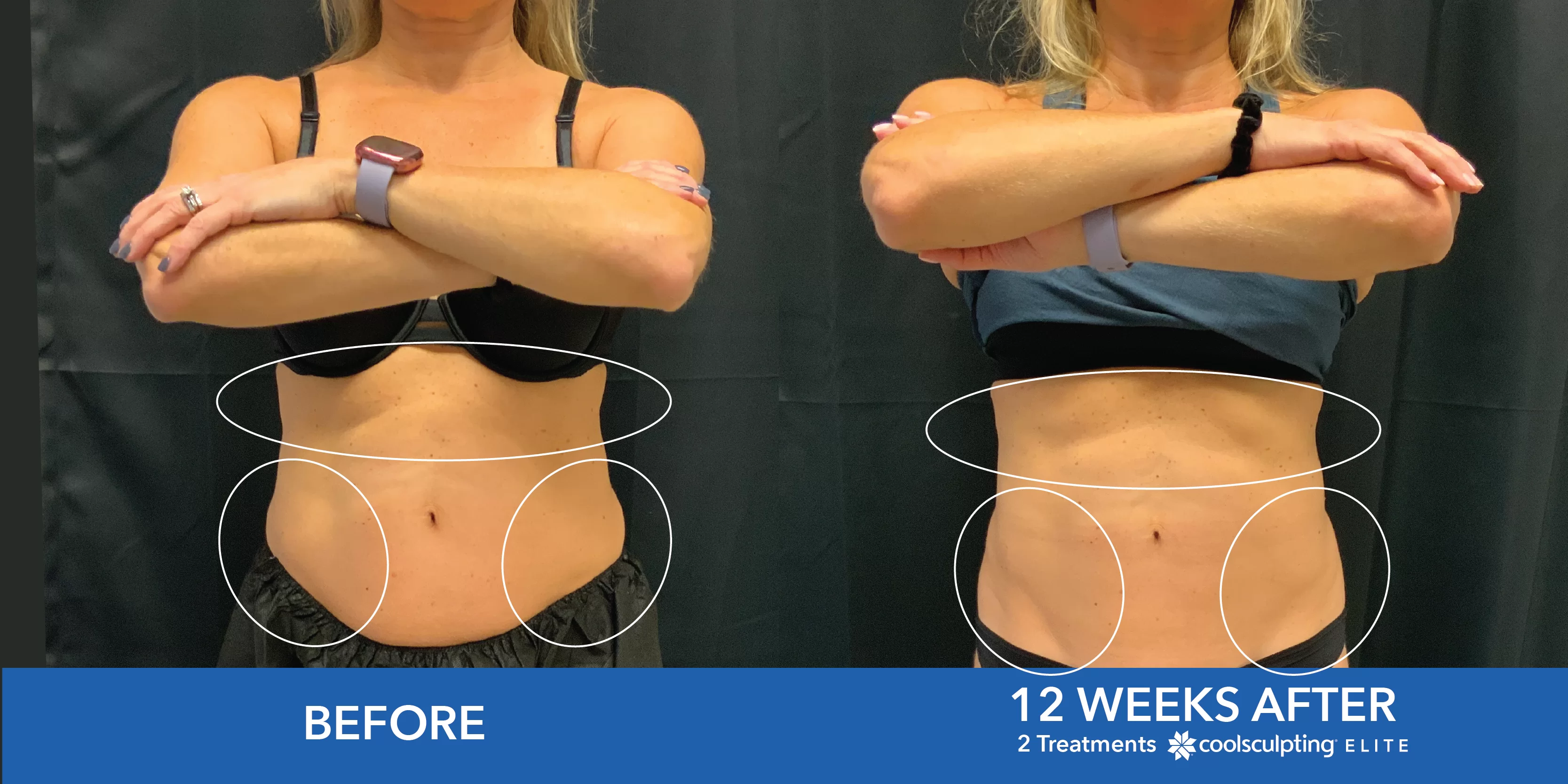 CoolSculpting Before and After on the Stomach
