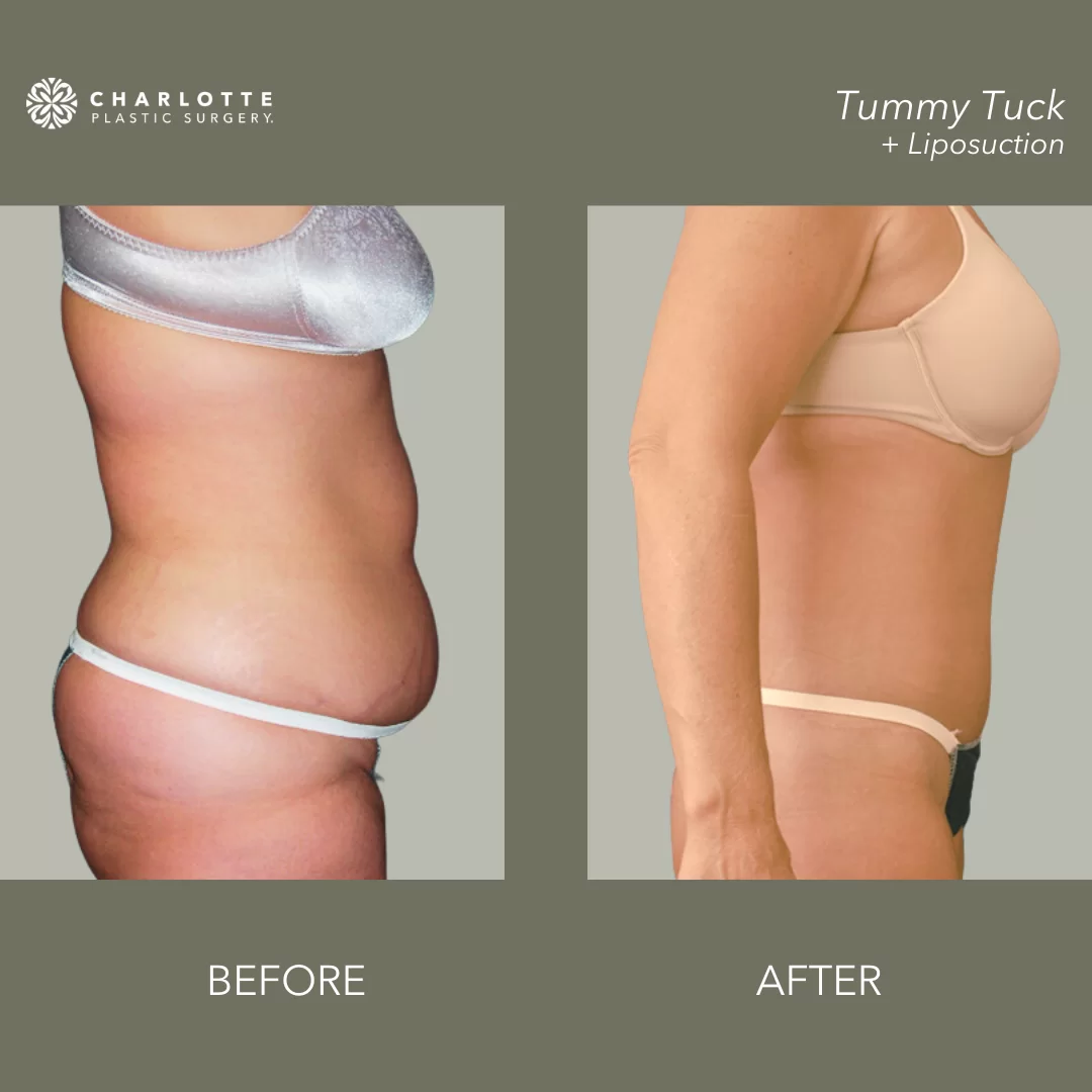 Tummy Tuck Ab board post surgery liposuction 360 use with Lipo