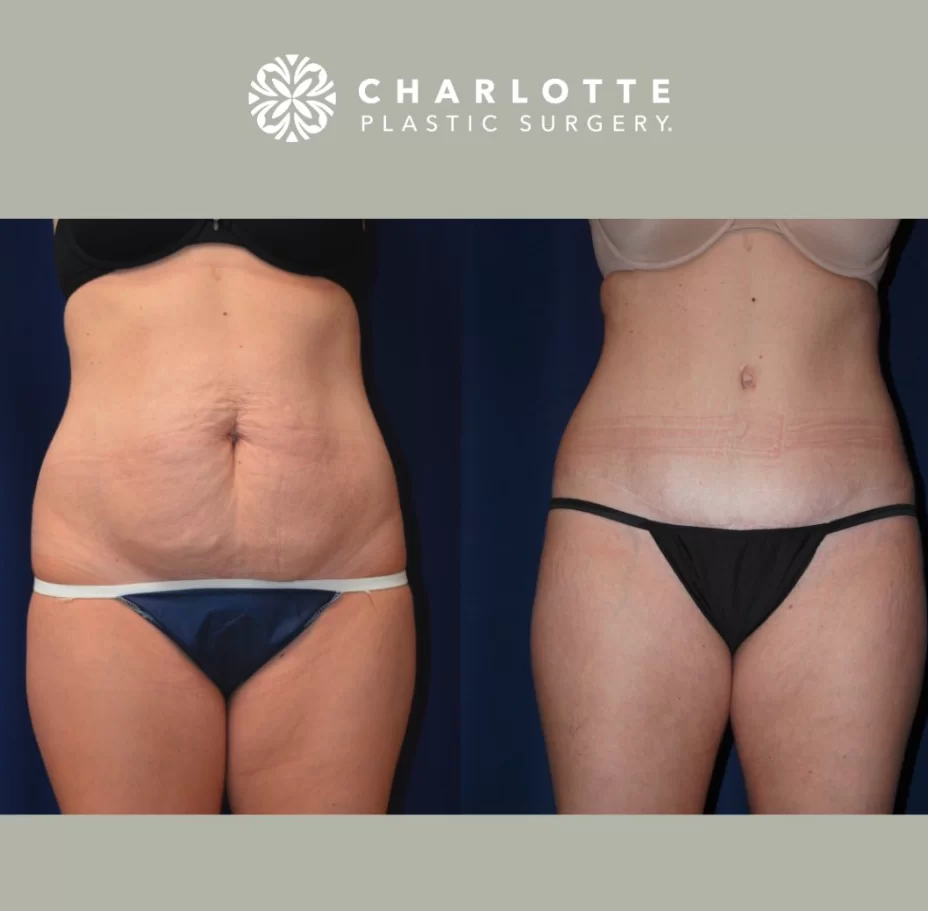 surgical and non-surgical body contouring
