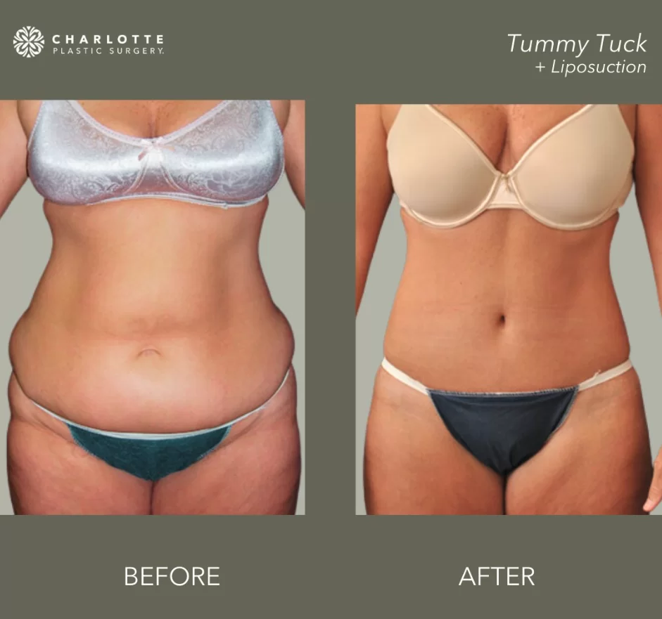 Body Lift vs Tummy Tuck