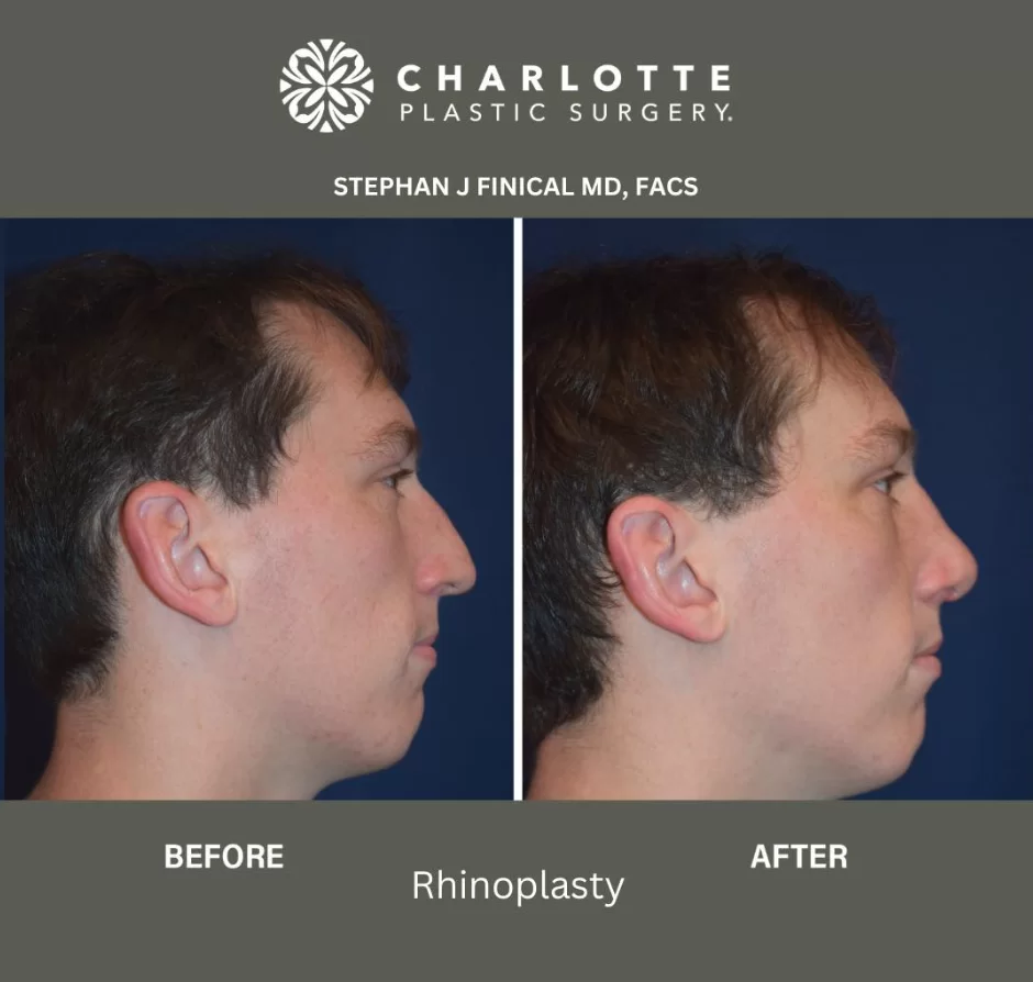 how much does a rhinoplasty costs